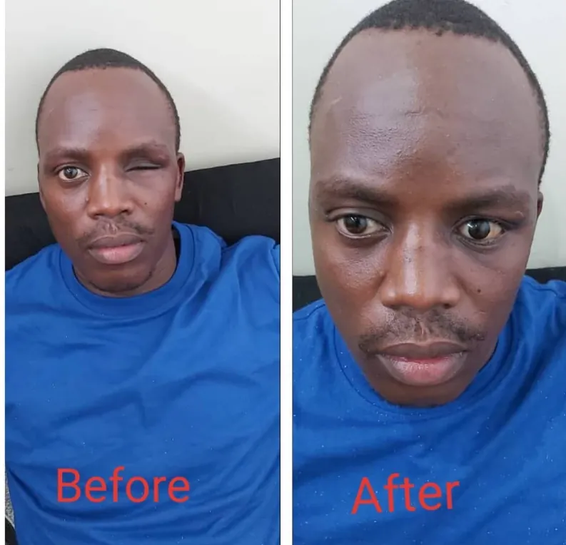 Before and after photos of a Siha Optical & Eye Center patient showing improved eyelid position and eye alignment
